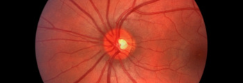 Eye Disease Management